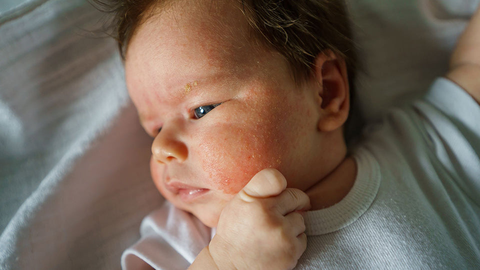 3 Why Your Baby’s Skin May Be Dry