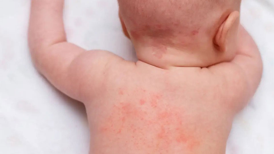 Heat Rash in Babies